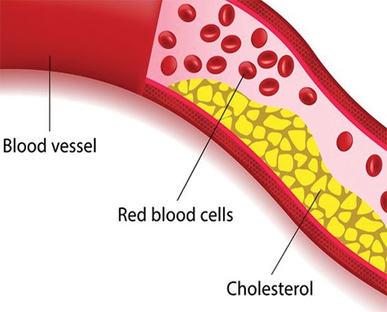 How Stress Impacts Your Cholesterol Level